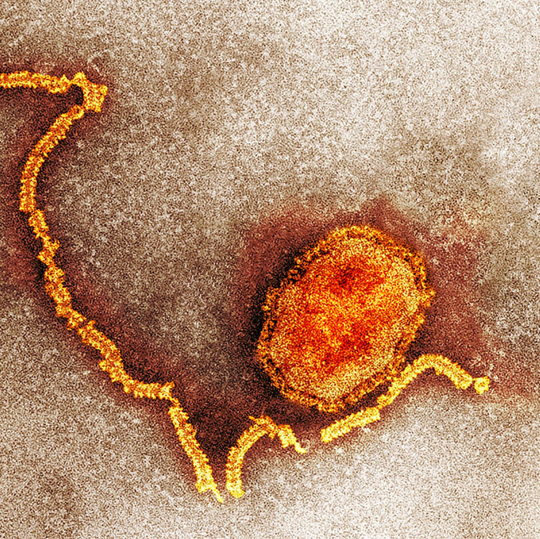A 1990 Measles Outbreak Shows How the Disease Can Roar Back