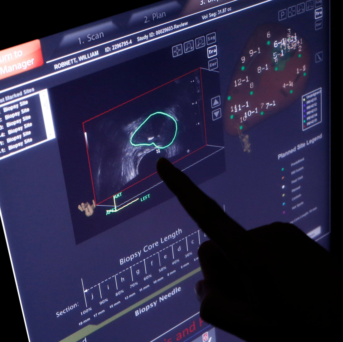 Cancer Is Surging, Bringing a Debate About Whether to Look for It